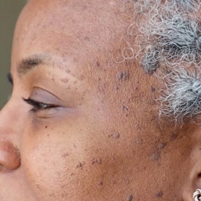 Close-up side profile of a patient with DPN spots on the cheek before removal treatment in Ajax