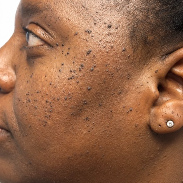 Close-up side profile of a patient with DPN spots on the cheek before removal treatment in Ajax