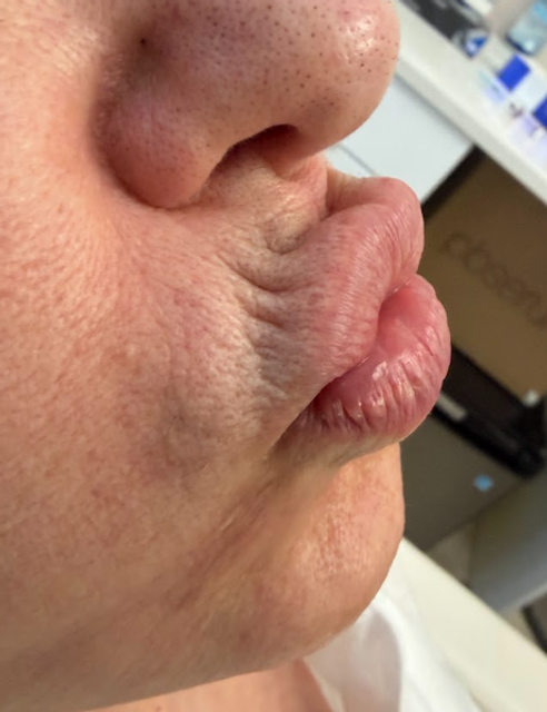 side profile of a woman's lips before botox treatment in Ajax
