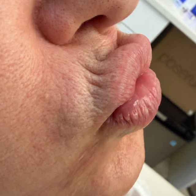 side profile of a woman's lips before botox treatment in Ajax