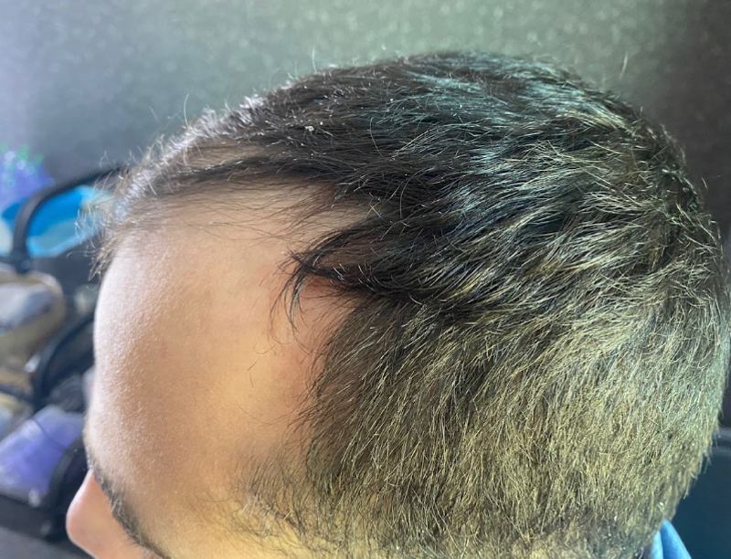PRP for Fuller-Looking Hair before treatment