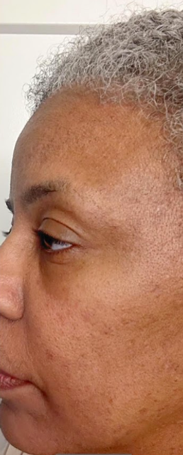 Close-up side profile of a patient with DPN spots on the cheek before removal treatment in Ajax