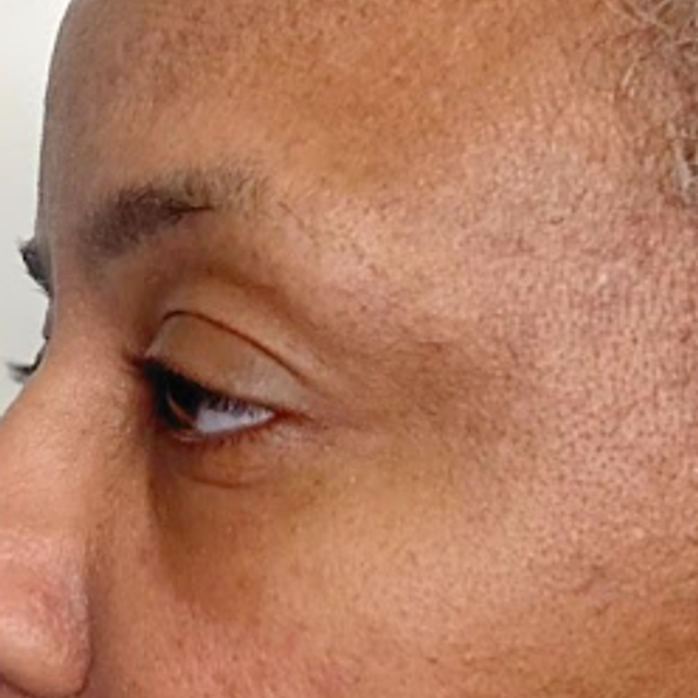Close-up side profile of a patient with DPN spots on the cheek before removal treatment in Ajax