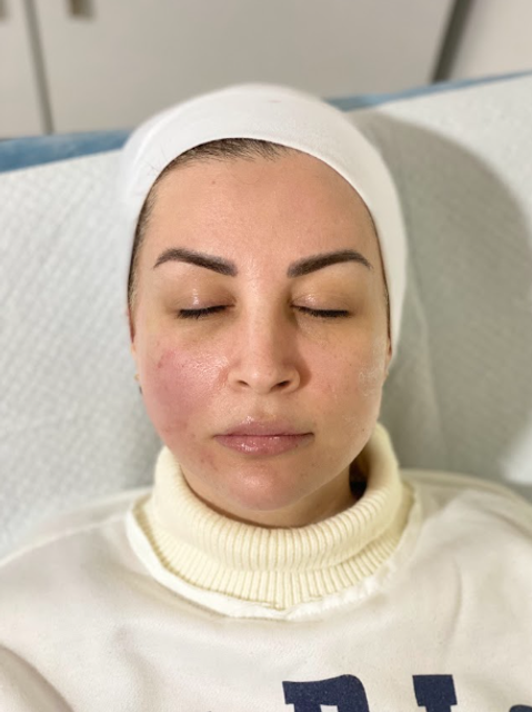 Woman with eyes closed wearing a white headband, shown After thread lift treatment in Ajax.