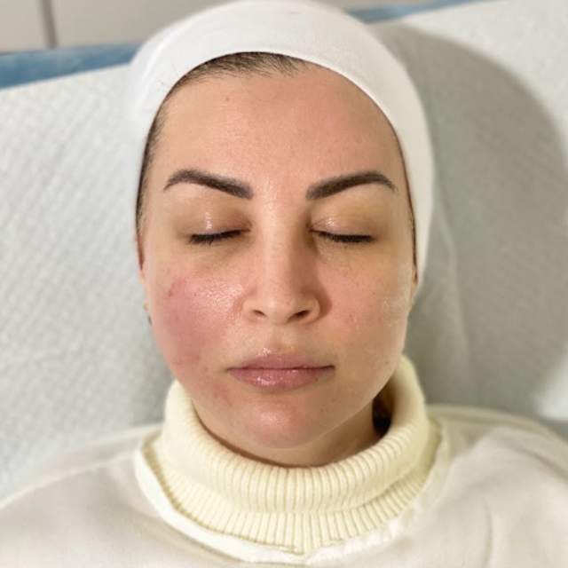 Woman with eyes closed wearing a white headband, shown After thread lift treatment in Ajax.
