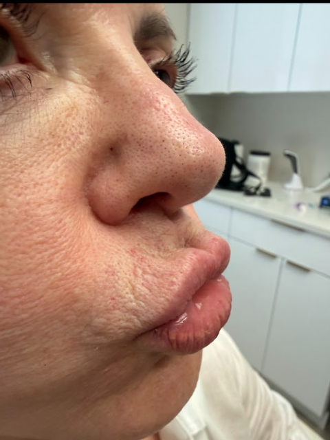 side profile of a woman's lips after botox treatment in Ajax
