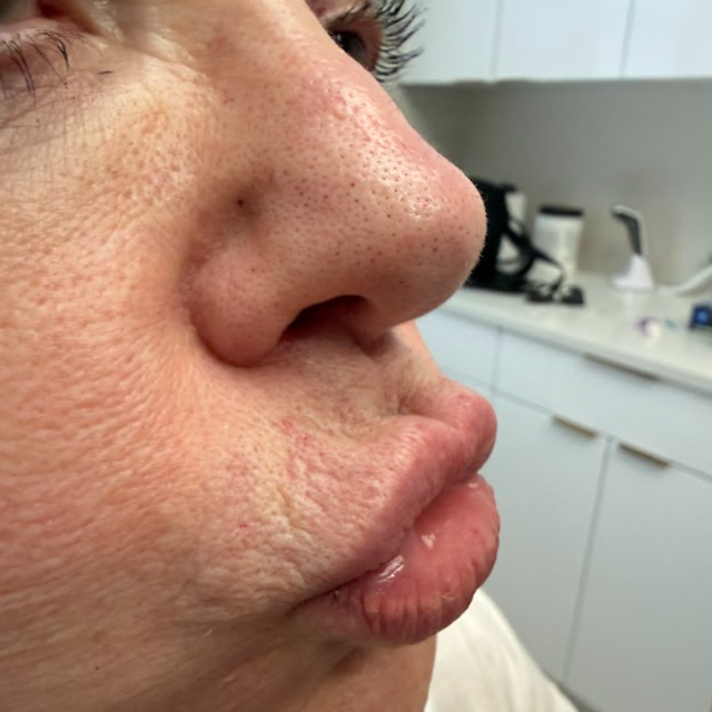 side profile of a woman's lips after botox treatment in Ajax