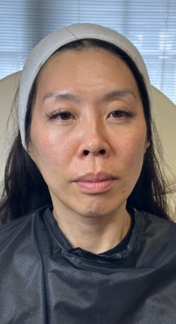 Frontal view of a woman's face after a non-laser carbon peel facial in Ajax