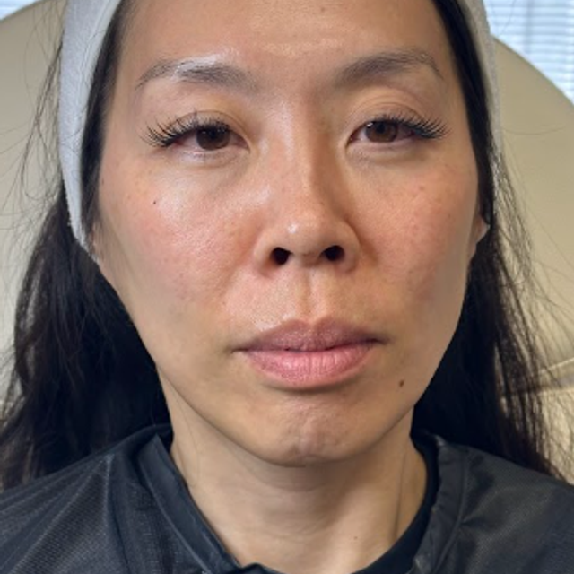 Frontal view of a woman's face after a non-laser carbon peel facial in Ajax