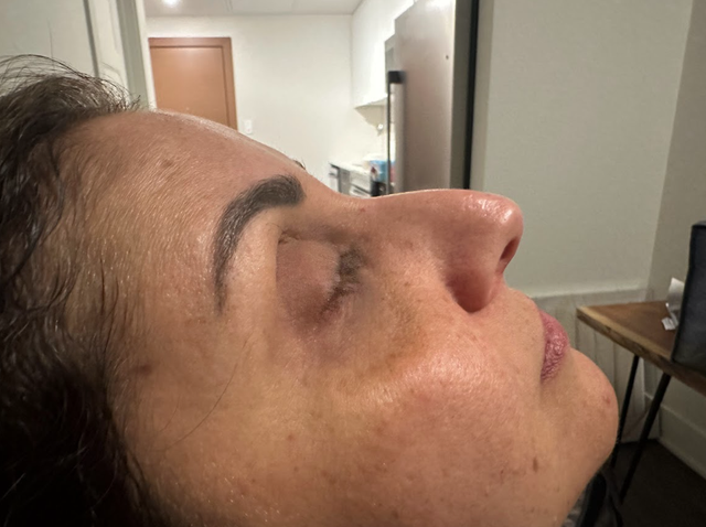 Side profile of a woman's nose before a non-surgical rhinoplasty treatment in Ajax