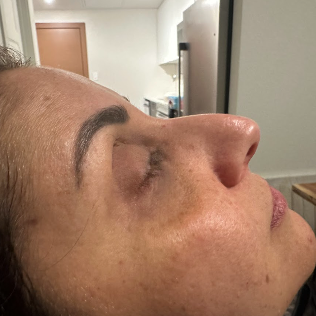 Side profile of a woman's nose before a non-surgical rhinoplasty treatment in Ajax