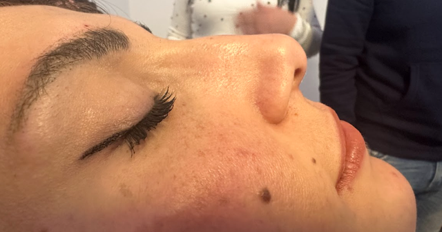 Side profile of a woman's nose before a non-surgical rhinoplasty treatment in Ajax