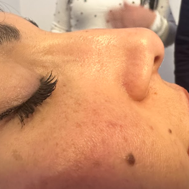 Side profile of a woman's nose before a non-surgical rhinoplasty treatment in Ajax
