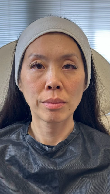 Frontal view of a woman's face before a non-laser carbon peel facial in Ajax