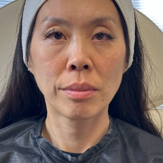 Frontal view of a woman's face before a non-laser carbon peel facial in Ajax