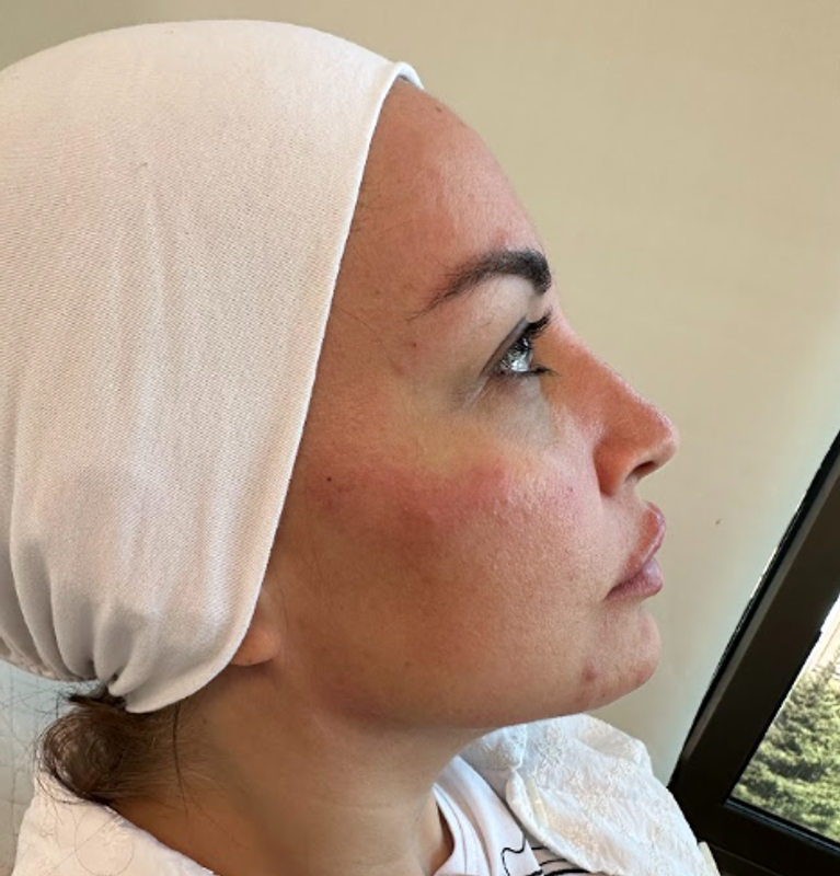 Natural-Looking Facial Enhancement after treatment
