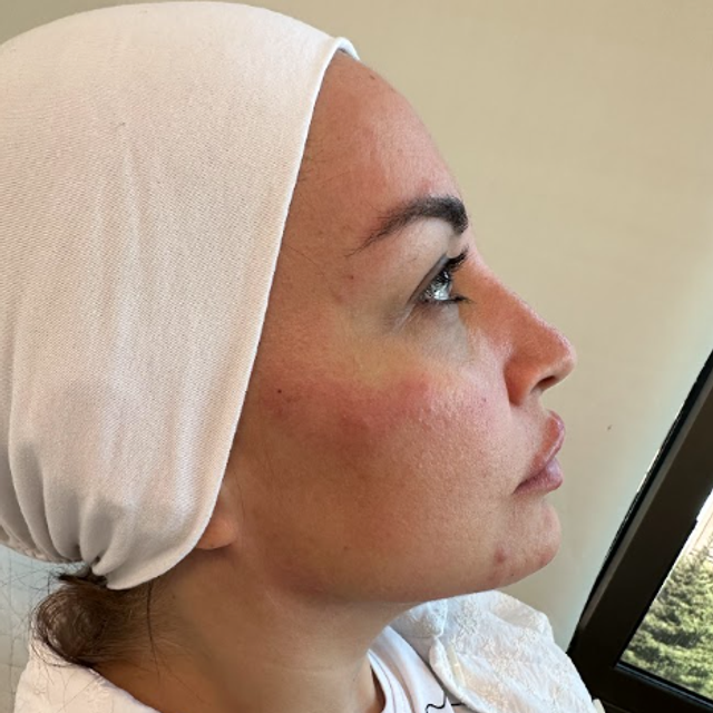 Side profile of a woman's face after a facial dermal filler treatment in Ajax