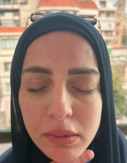 front profile of a woman's face after forehead botox treatment in Ajax