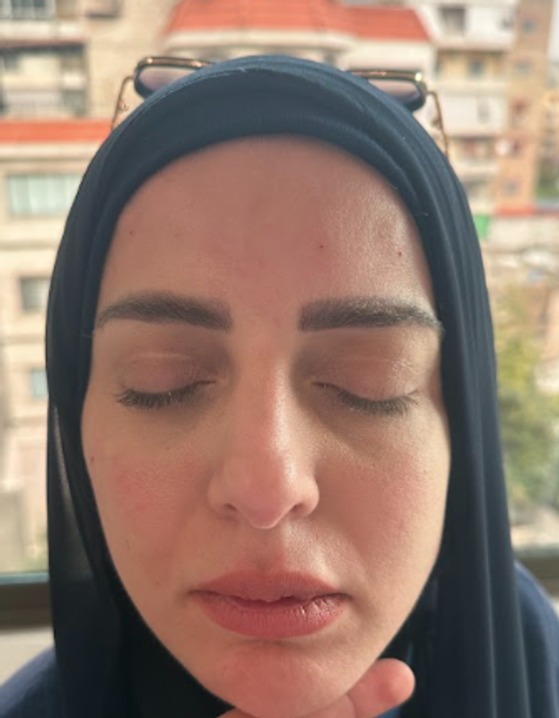 Botox — Smoother, Youthful-Looking Skin after treatment