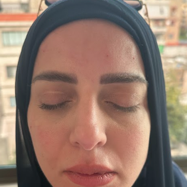 front profile of a woman's face after forehead botox treatment in Ajax