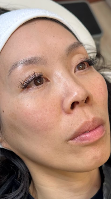 Frontal view of a woman's face before a non-laser carbon peel facial in Ajax