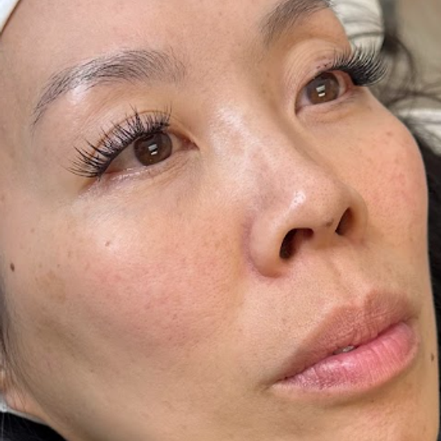 Frontal view of a woman's face before a non-laser carbon peel facial in Ajax