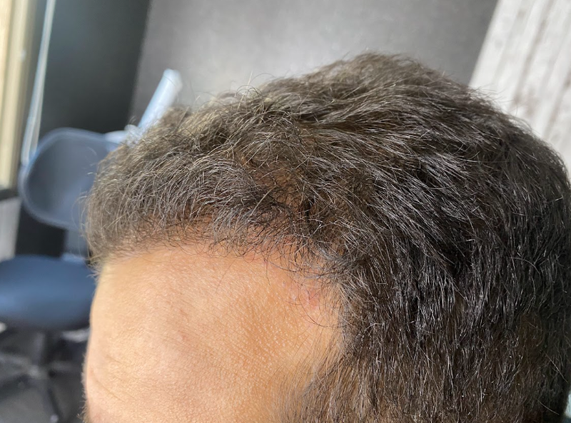 PRP for Fuller-Looking Hair after treatment