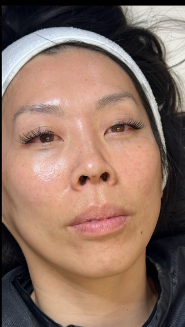 Frontal view of a woman's face after a non-laser carbon peel facial in Ajax