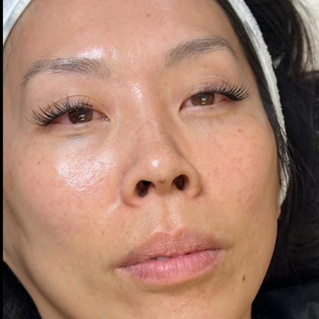 Frontal view of a woman's face after a non-laser carbon peel facial in Ajax