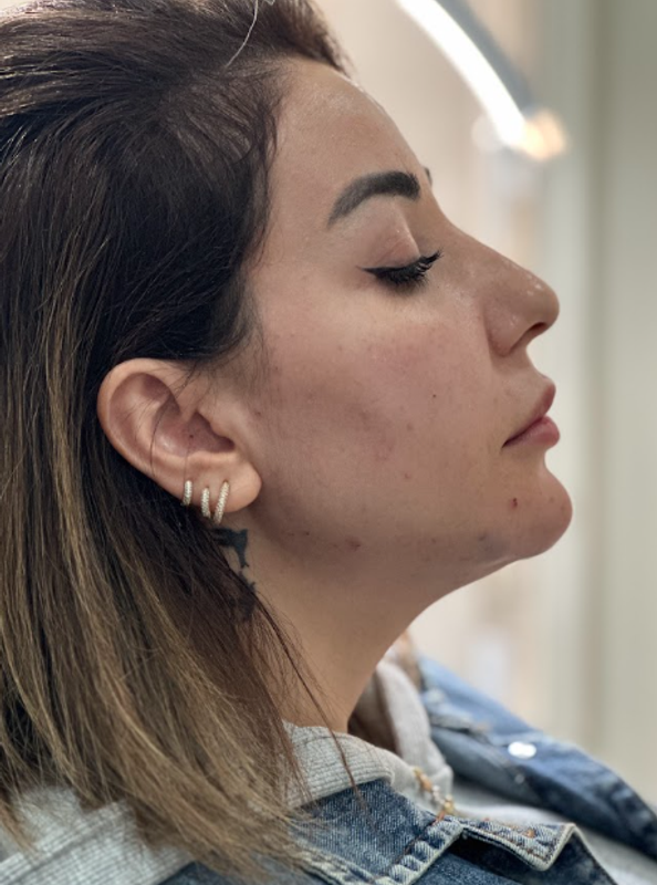 Filler - Natural-Looking Facial Enhancement after treatment