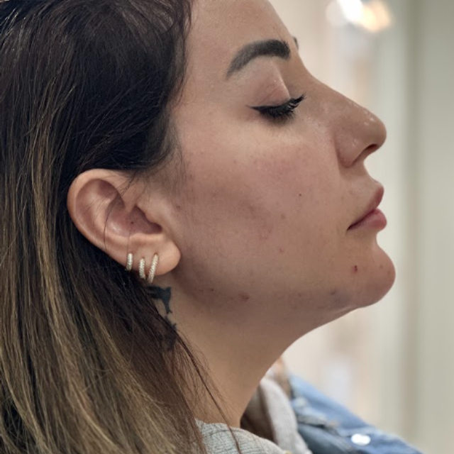side profile of a woman's face after a Jawline filler treatment in Ajax