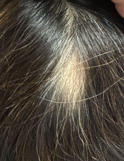 Close-up of a bald spot on a scalp after a PRP hair restoration treatment in Ajax