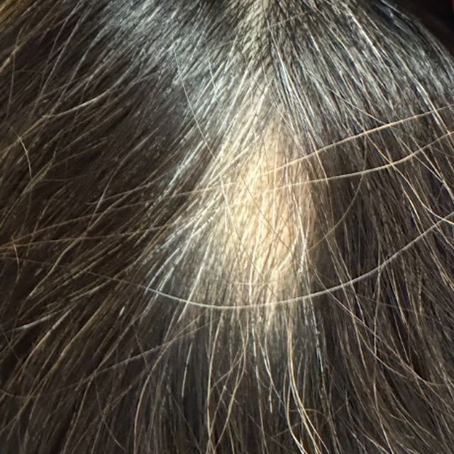 Close-up of a bald spot on a scalp after a PRP hair restoration treatment in Ajax