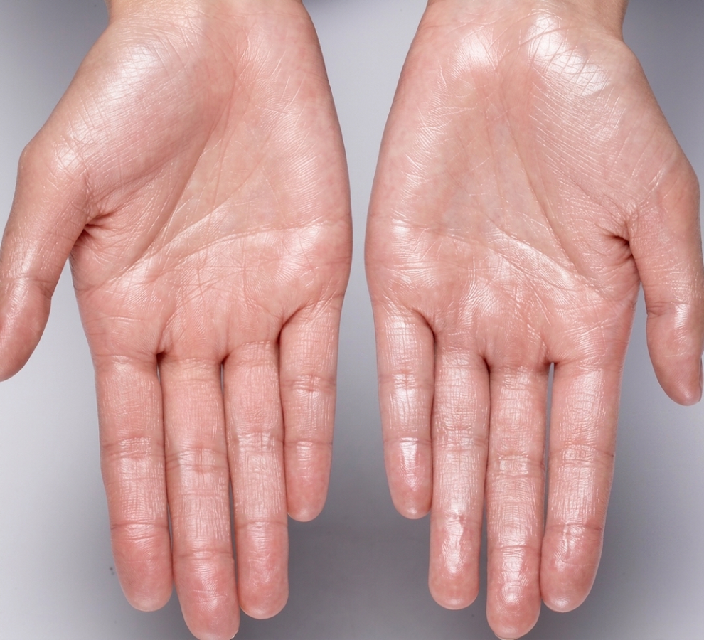 Pair of sweaty palms showing palmar hyperhidrosis before treatment at NU Age Aesthetic in Ajax