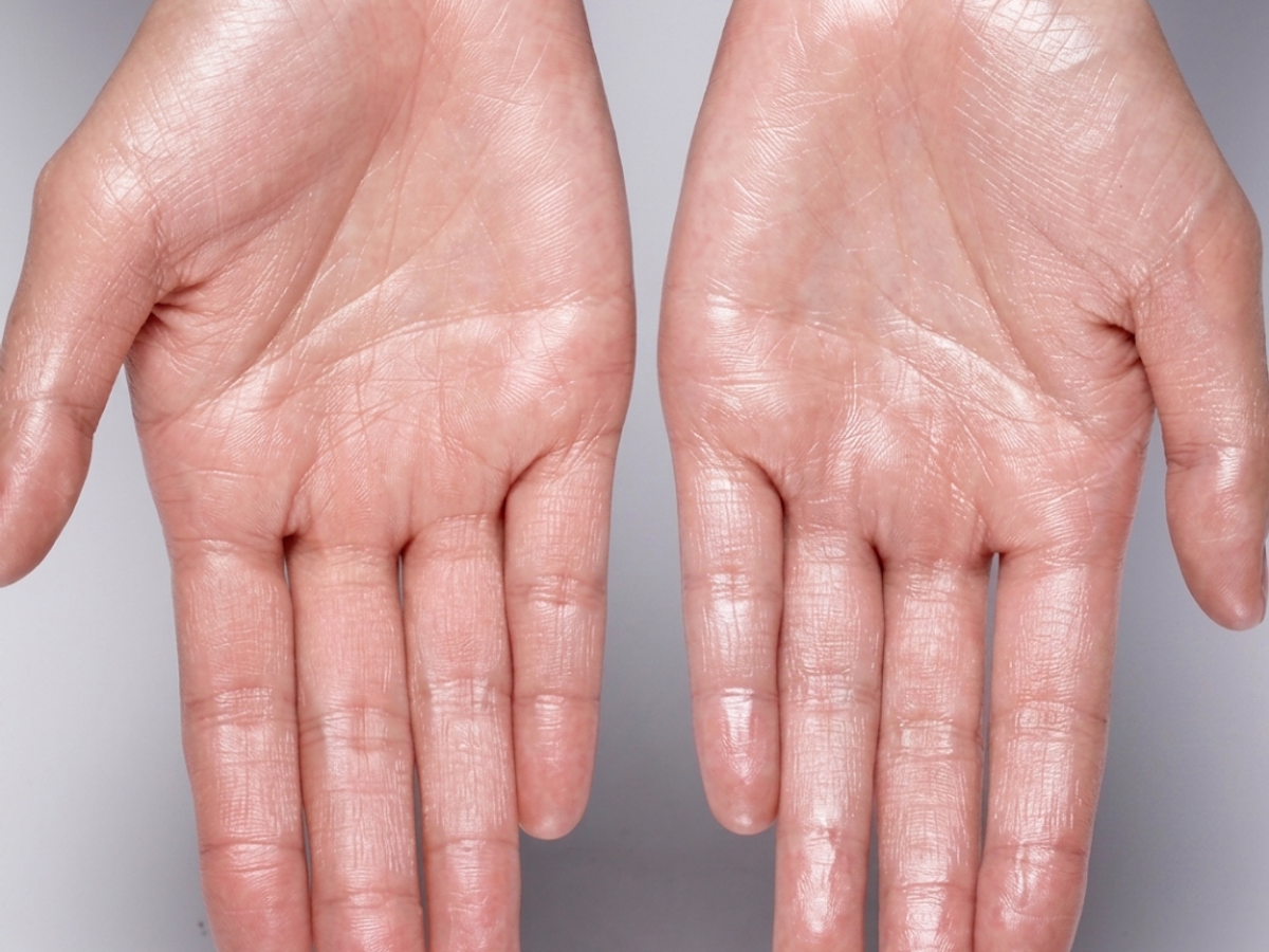 Pair of sweaty palms showing palmar hyperhidrosis before treatment at NU Age Aesthetic in Ajax