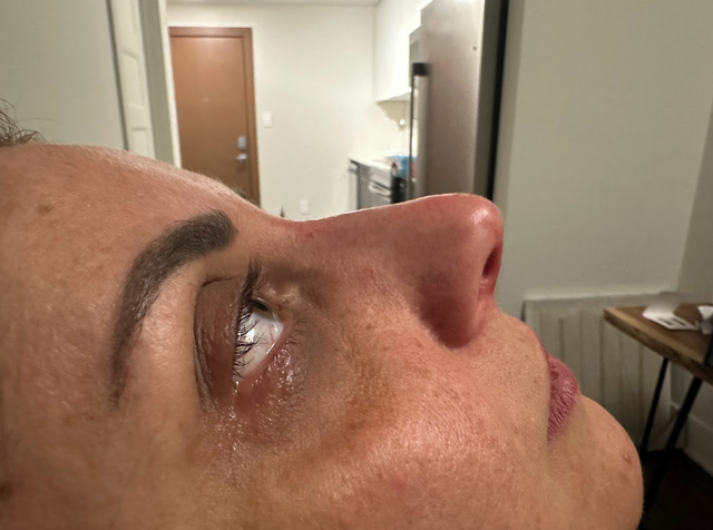 Side profile of a woman's nose after a non-surgical rhinoplasty treatment in Ajax