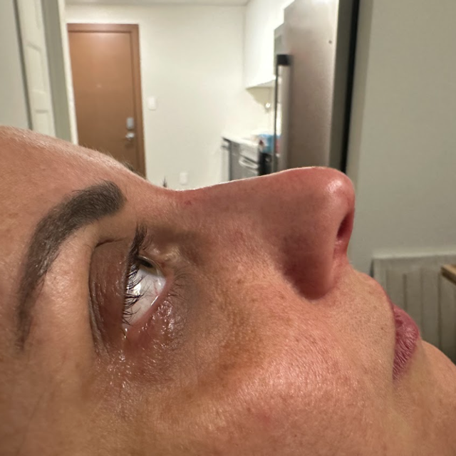 Side profile of a woman's nose after a non-surgical rhinoplasty treatment in Ajax
