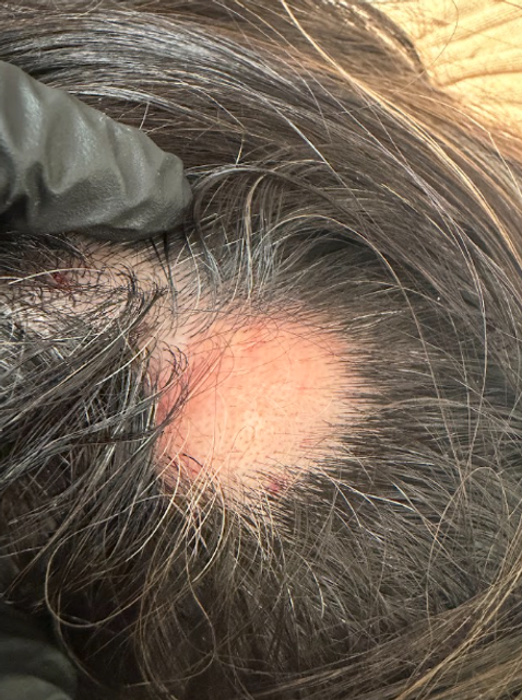 Close-up of a bald spot on a scalp before a PRP hair restoration treatment in Ajax