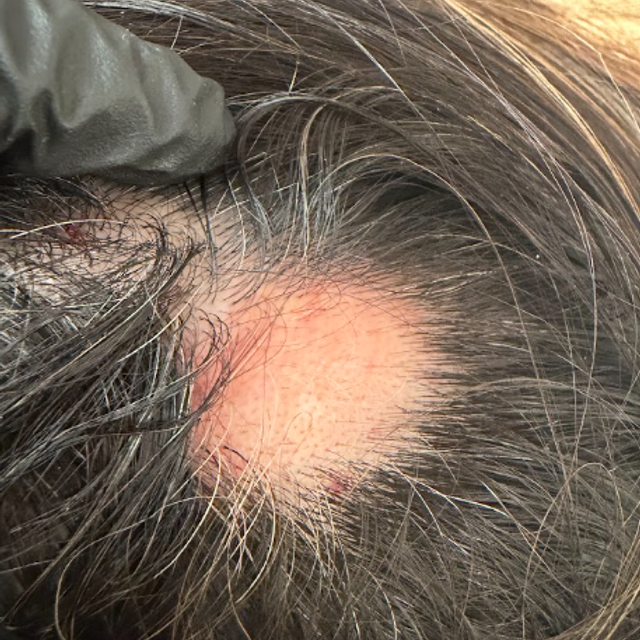 Close-up of a bald spot on a scalp before a PRP hair restoration treatment in Ajax