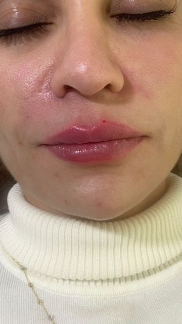 front profile of a woman's face after a lip filler treatment in Ajax