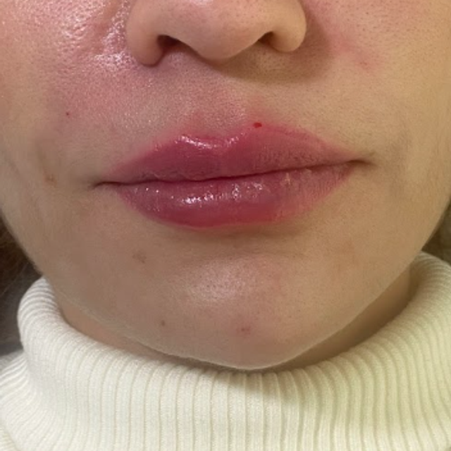 front profile of a woman's face after a lip filler treatment in Ajax