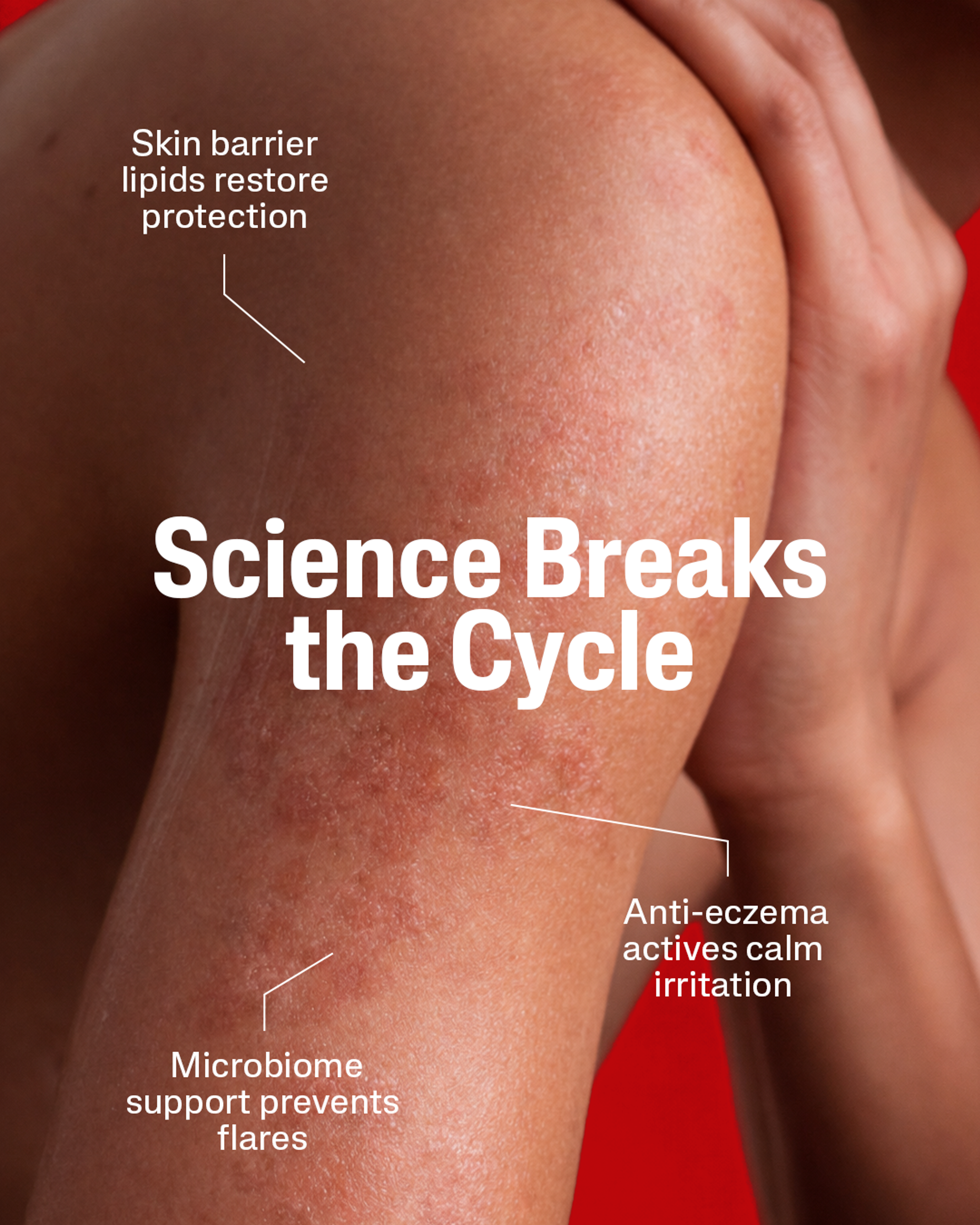 Modern Life Eczema