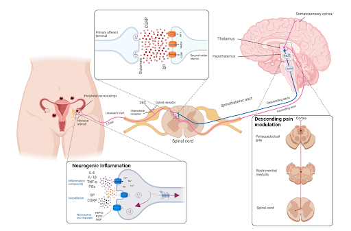 Diagram showing the pain pathway in endometriosis, from uterine inflammation and prostaglandin release to brain processing in the thalamus and somatosensory cortex, with involvement of neurotransmitters like glutamate, substance P, and CGRP, and modulation by the periaqueductal gray (PAG) and descending pain control.