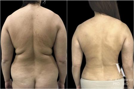 липосакция