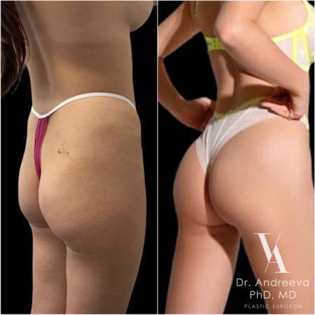 липосакция