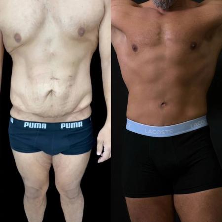 липосакция