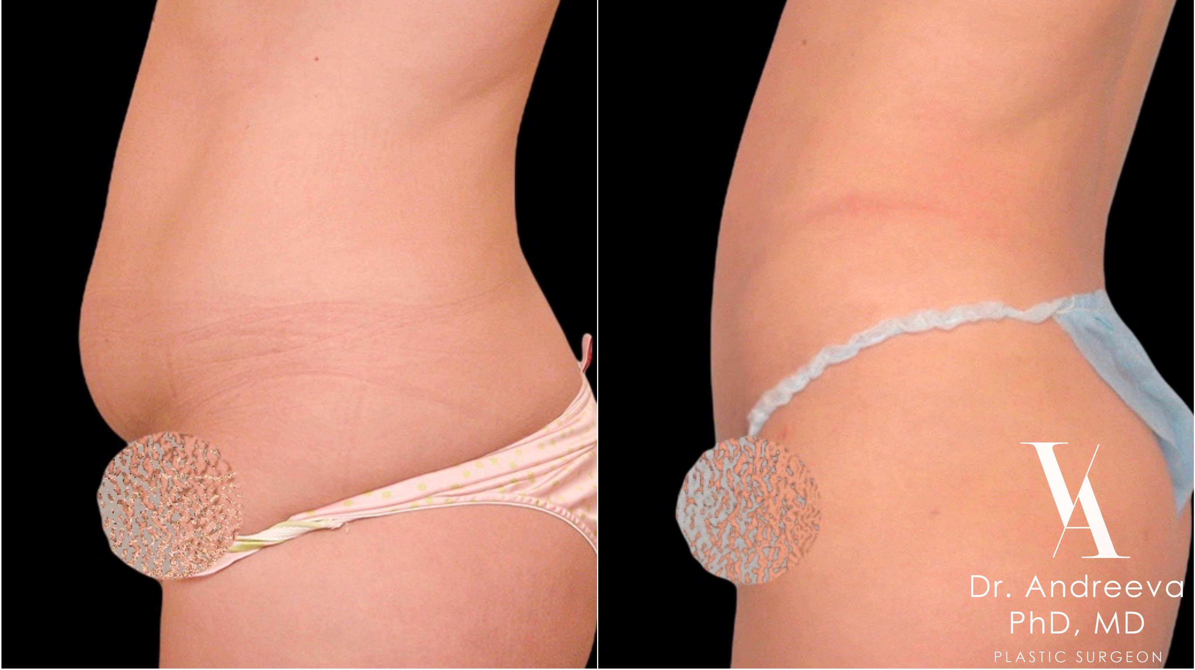 липосакция