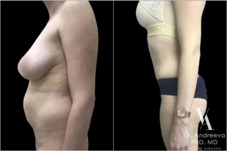 липосакция