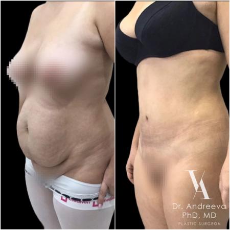 липосакция