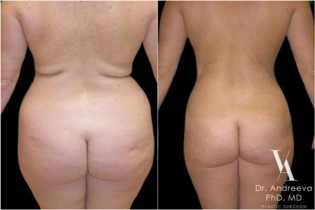 липосакция